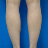 BX leg before.jpgのサムネール画像のサムネール画像